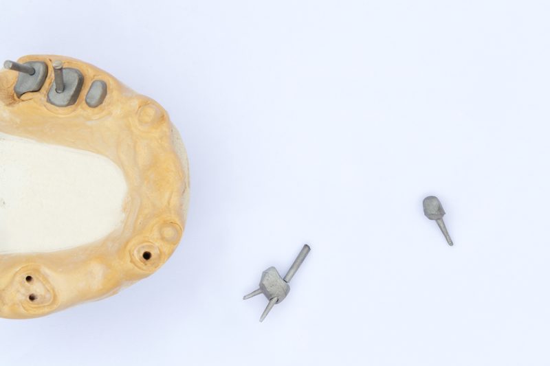 Cast post and core — dental post Sydney lab